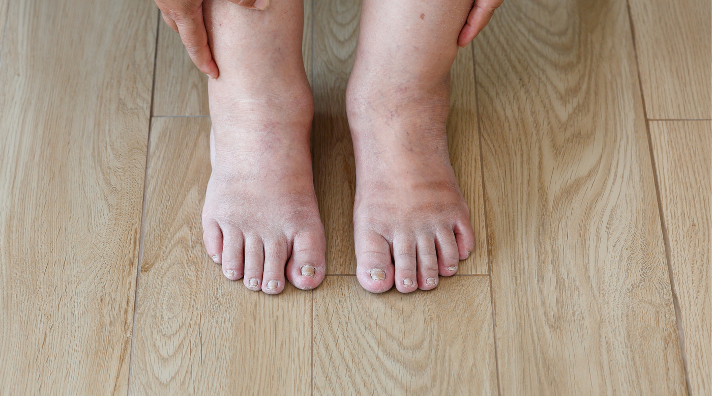 Purple Feet Diabetes Exploring Its Causes and Symptoms Circufiber