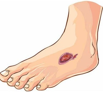 Non Diabetic Foot Ulcer